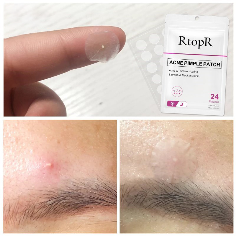 ClearSkin® | Acne Pimple Patch (30% OFF) - JUSTSIS®